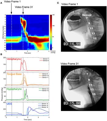 Methods for Measuring Swallowing Pressure Variability Using High-Resolution Manometry